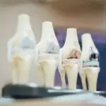 Tipos de Cirurgias de Reconstrução Ligamentar do Joelho - Prof. Dr. Sérgio Piedade Artroplastia Revisional