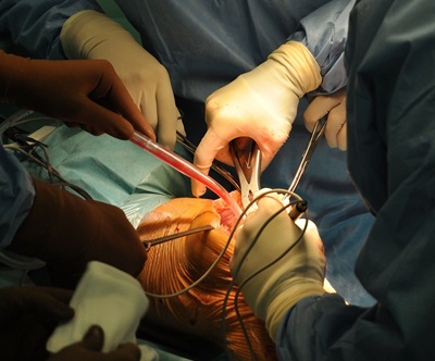 Cirurgia LCP